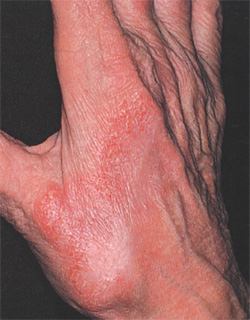 Контактный дерматит, фото