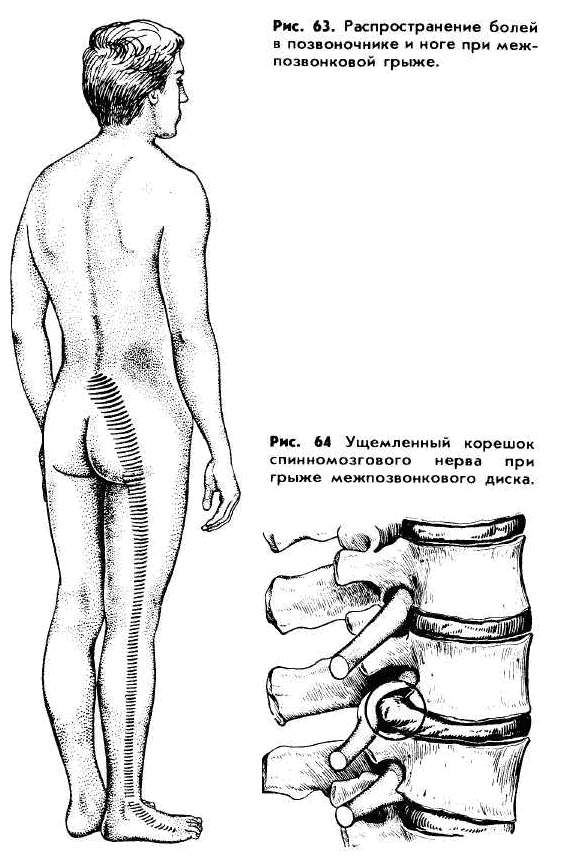 Болит нога от позвоночника. Грыжи позвоночника в поясничном отделе схема. Боли при грыже поясничного отдела позвоночника. Иррадиация боли при грыже поясничного отдела.