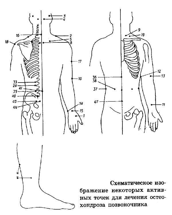 Банки при болях в спине. Акупунктурные точки при боли в пояснице. Акупунктурные точки при шейном остеохондрозе. Точечный массаж спины схема. Точечный массаж спины болевые точки.